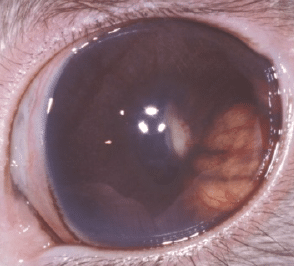 Encephalitozoon cuniculi, rabbit, torticoli, cataract, mass, eye, parasite