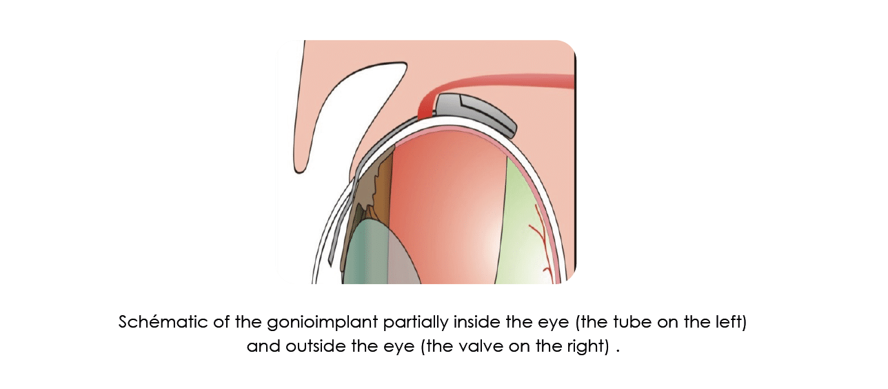 gonioimplant, glaucoma,Surgical options, glaucoma, eye, pressure, cat , dog