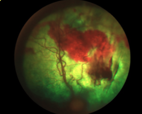 Hypertensive retinopathy, hypertension, kidney disease, hyperthyroidism, cat, blindness, glaucoma, bleeding, retinal detachment, pain