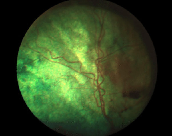 Hypertensive retinopathy, hypertension, kidney disease, hyperthyroidism, cat, blindness, glaucoma, bleeding, retinal detachment, pain