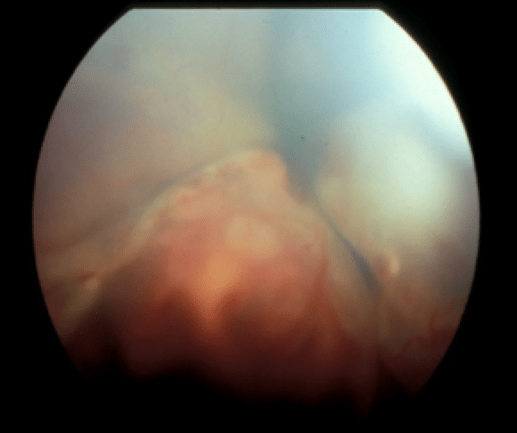 Hypertensive retinopathy, hypertension, kidney disease, hyperthyroidism, cat, blindness, glaucoma, bleeding, retinal detachment, pain