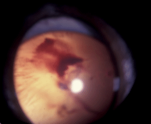 rétinopathie hypertensiveHypertensive retinopathy, hypertension, kidney disease, hyperthyroidism, cat, blindness, glaucoma, bleeding, retinal detachment, pain