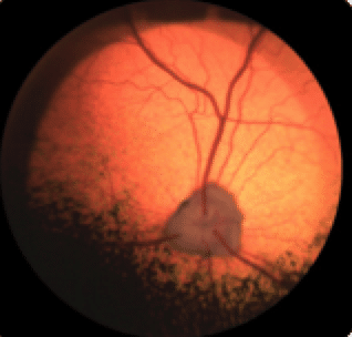 Sudden acquired retinal degeneration, SARD, blindness, lost of vision, dog, female, middle age