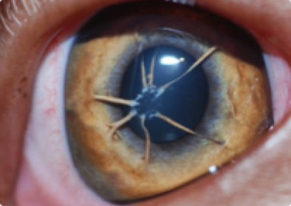 Persistance de membrane pupillaire